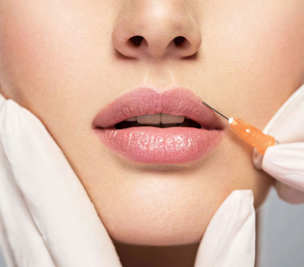 Lip Fillers